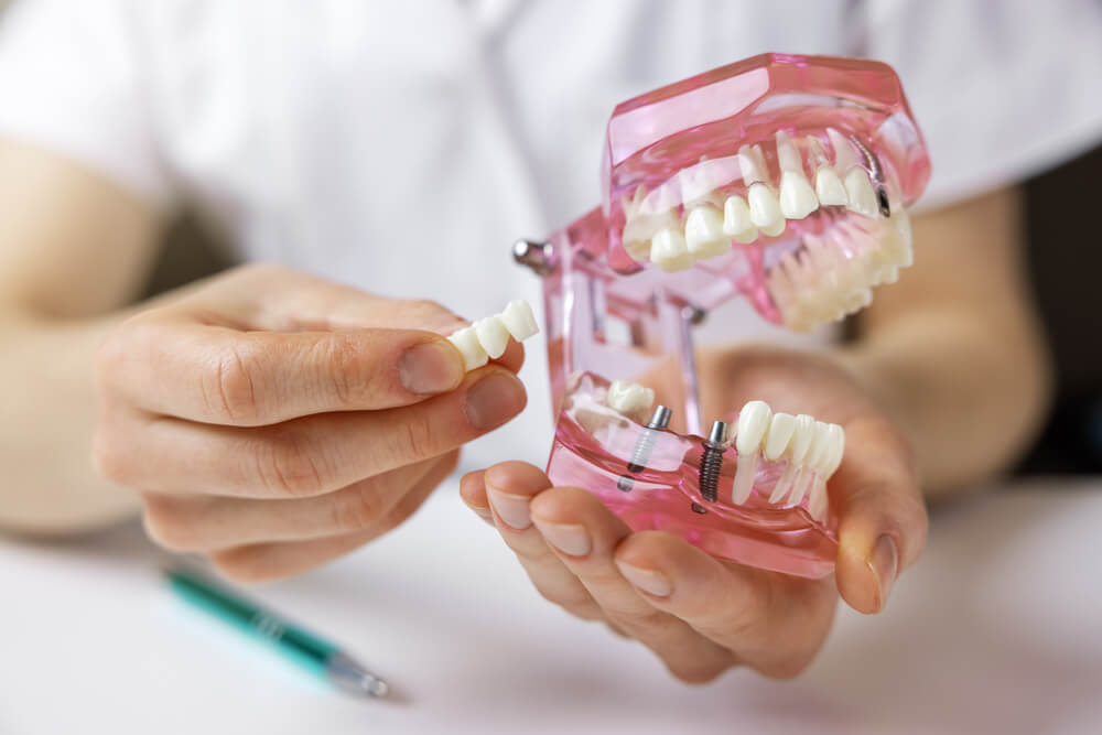 Dental Bridges in Newnan, GA