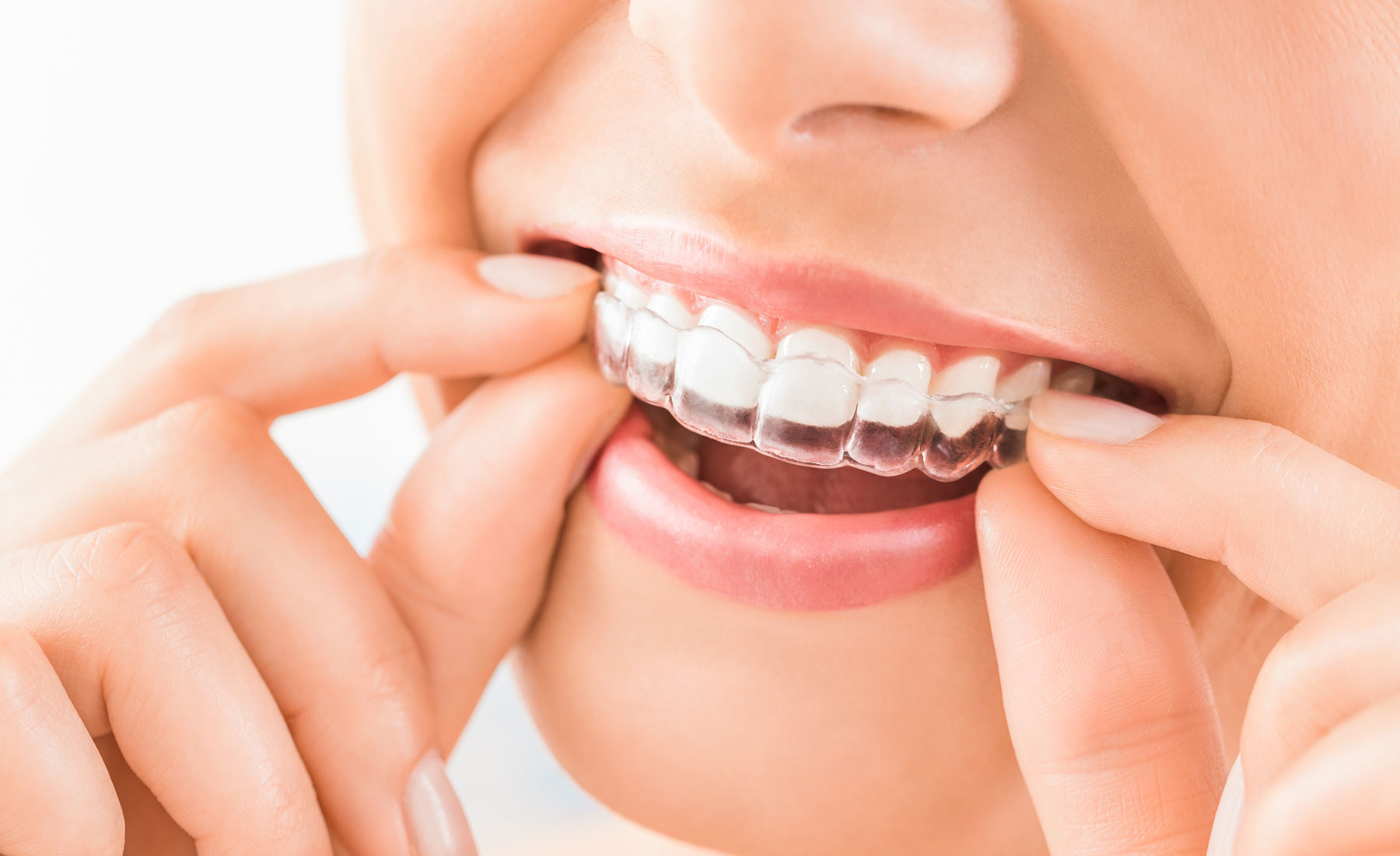 Considering online clear aligners? Read this first!