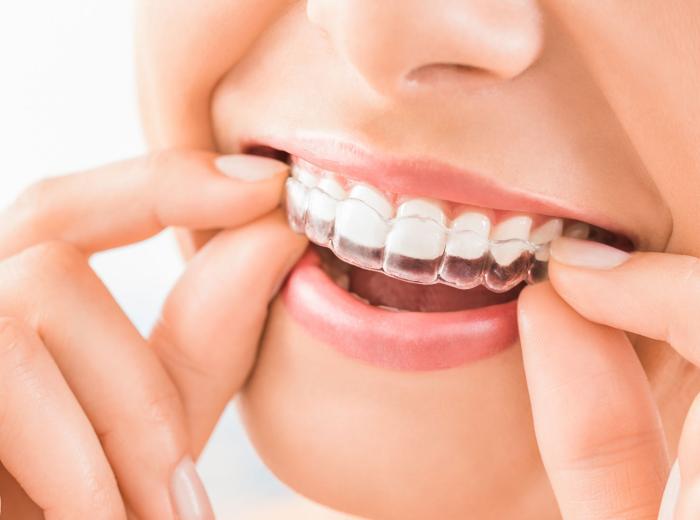 Considering online clear aligners? Read this first!