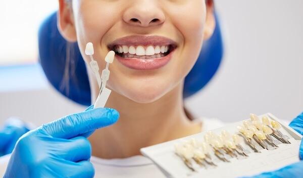 Veneers
